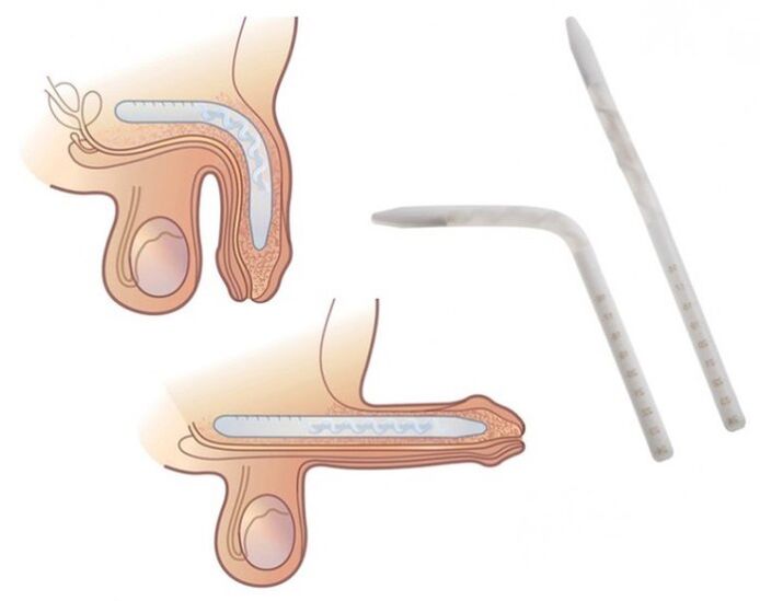 Falloplasty to increase a member