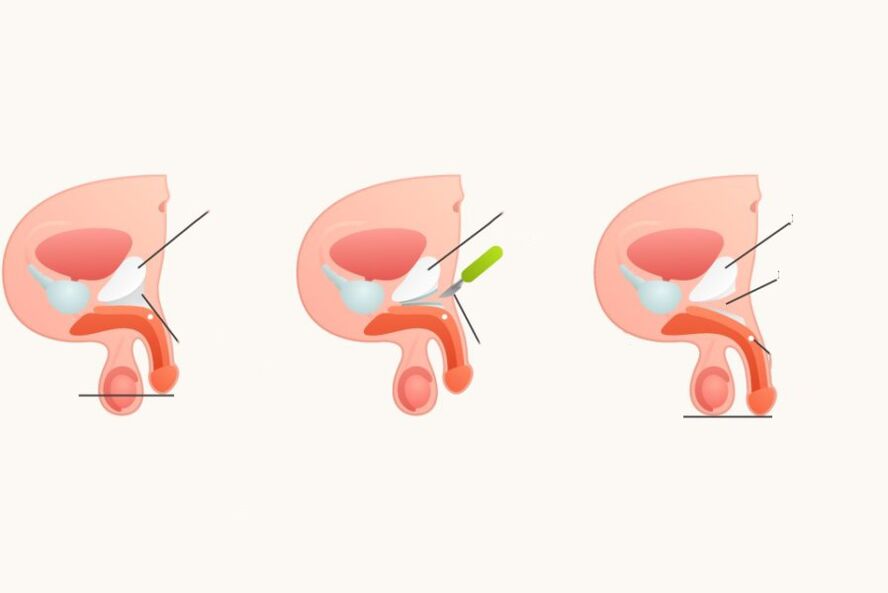 Ligamentomotomy to increase the penis