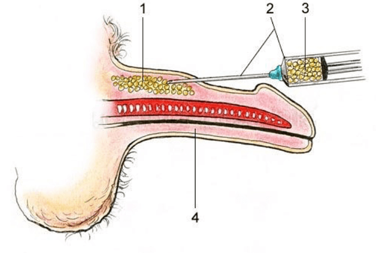 lipophiling to increase a member