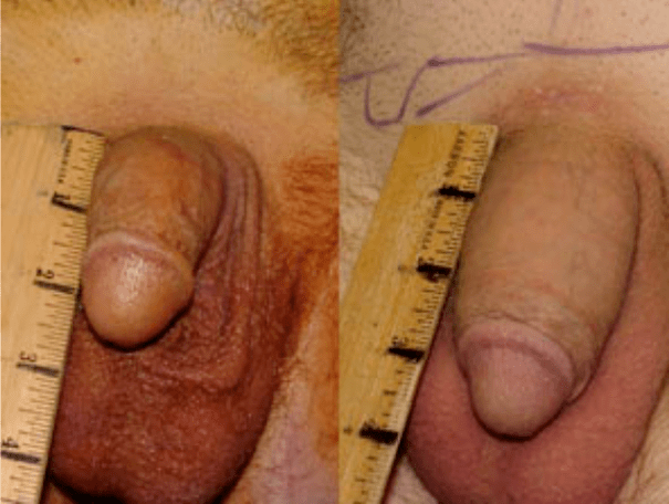 Before and after lipofilling and gel implantation.
