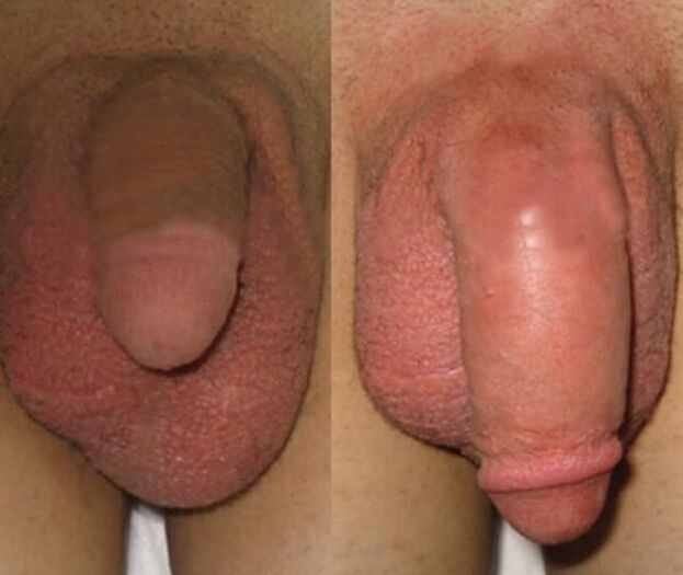 The result of installing a collagen matrix in the penis.