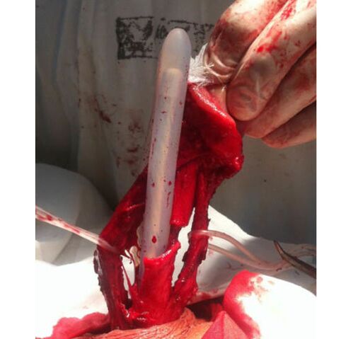 Muscle tissue transplant to enlarge the penis.