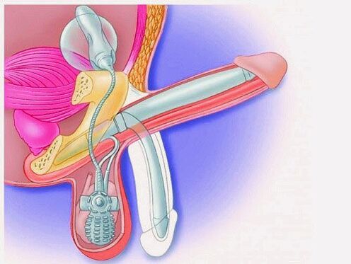 Penis enlargement using penile prosthesis